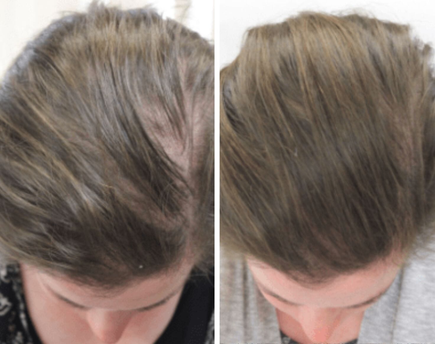 hair growth comparison